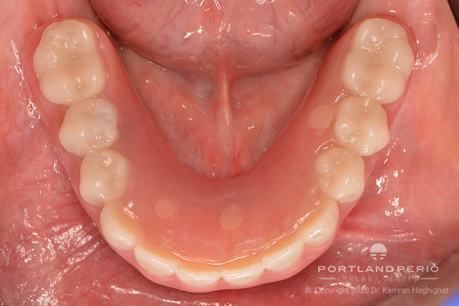 Lower arch of patient after All on Four dental implant treatment.