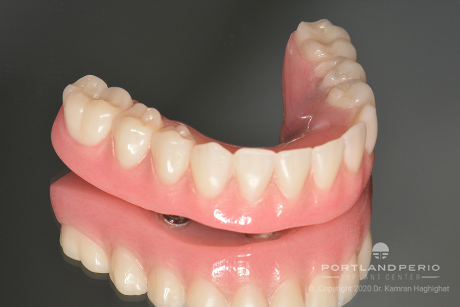 Lower jaw prosthesis for dental implant patient at Portland Perio Implant Center.