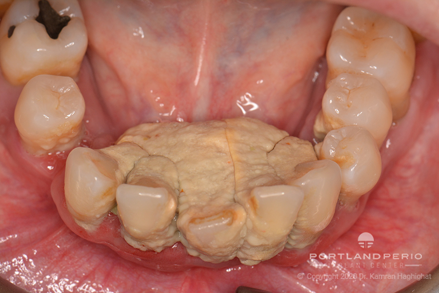 Lower arch of patient before All on Four dental implant treatment.