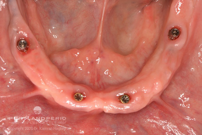 Lower arch implants