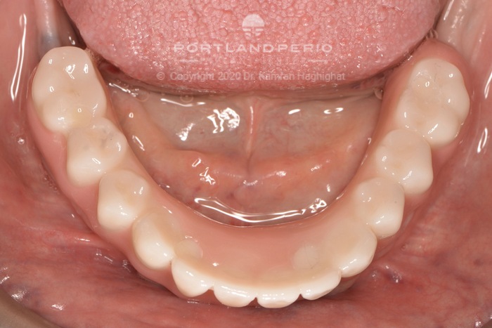 Lower prosthesis for all-on-four dental implants.