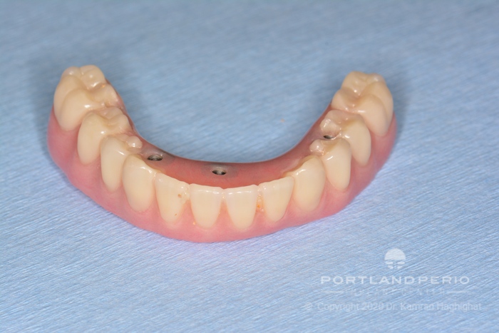 Lower jaw prosthesis using all on 4 dental implants.