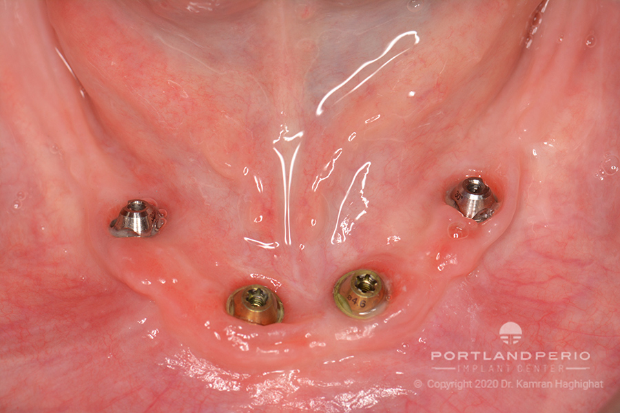 Lower jaw showing dental implant for treatment at Portland Perio Implant Center.