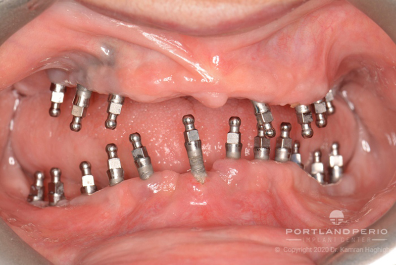 Patient with mini dental implants before removal.