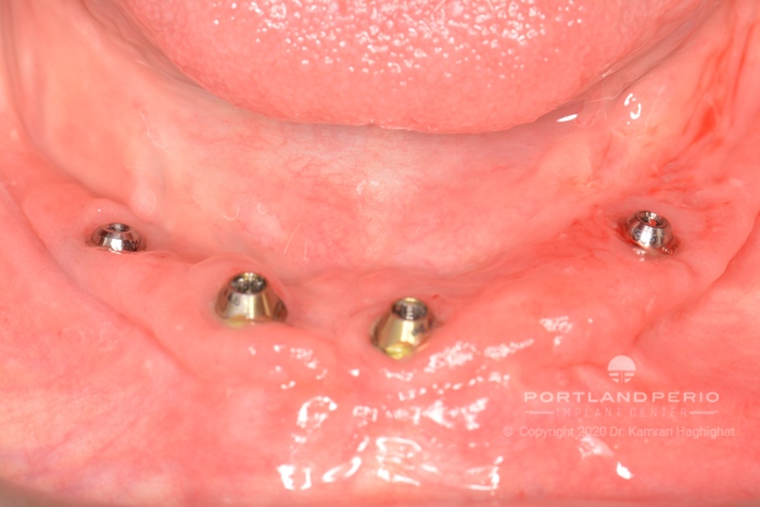Lower jaw dental implants placed.