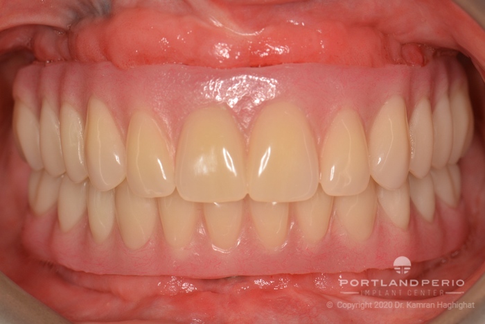 Upper and lower dental prosthesis for All On Four implants treatment.