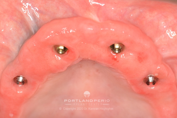 Upper jaw dental implants placed.