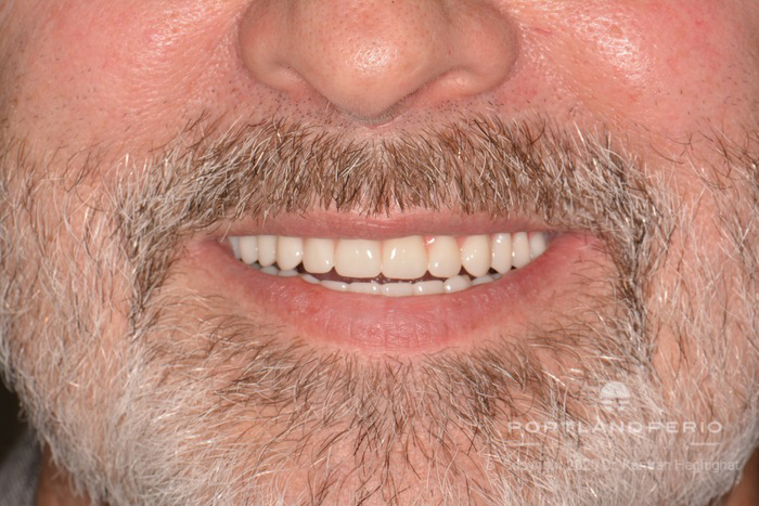 New smile of patient after all-on-4 dental implant treatment.