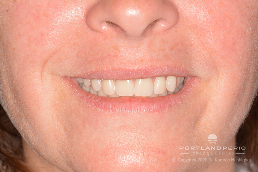 Smile of a happy patient after All on Four dental implant treatment with Dr. Kamran Haghighat.