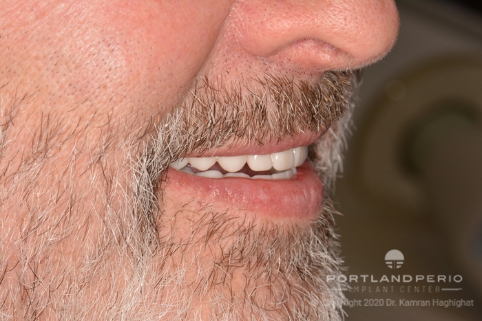 New smile of patient after all-on-4 dental implant treatment.