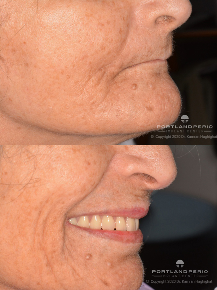 Patient before and after all on 4 dental implant treatment.