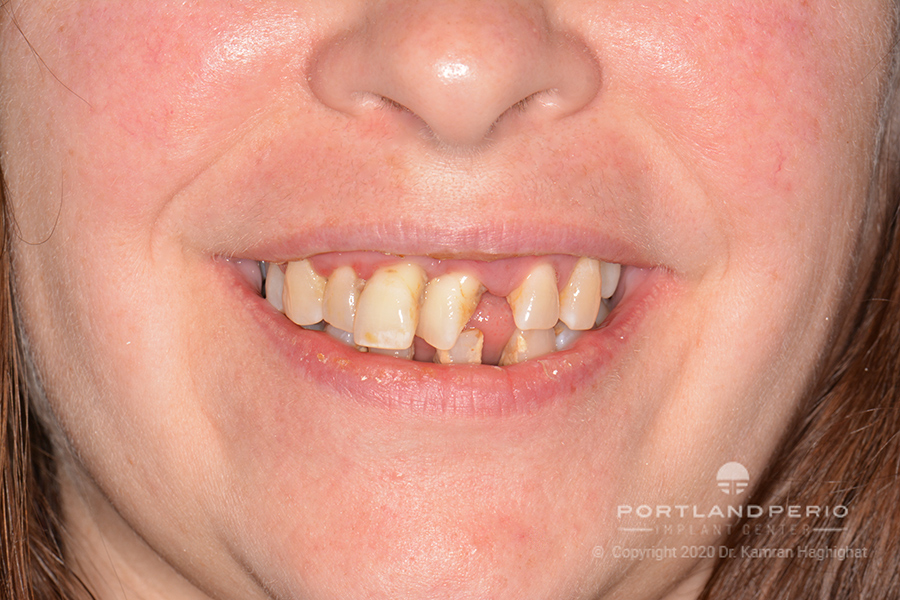 Smile showing patient before All on Four dental implant treatment at Portland Perio Implant Center.