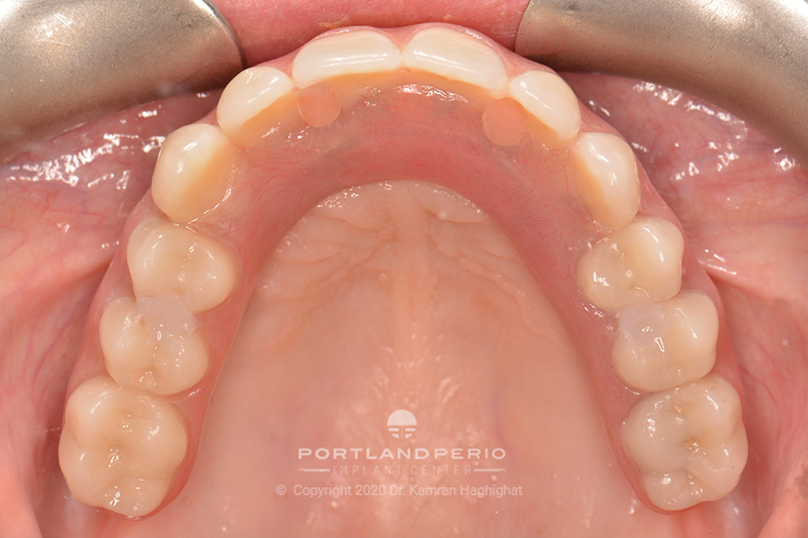 Upper arch of patient after All on Four dental implant treatment.