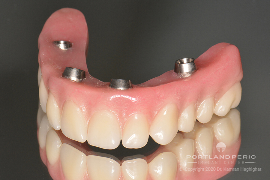 Upper prosthesis for dental patient at Portland Perio Implant Center.