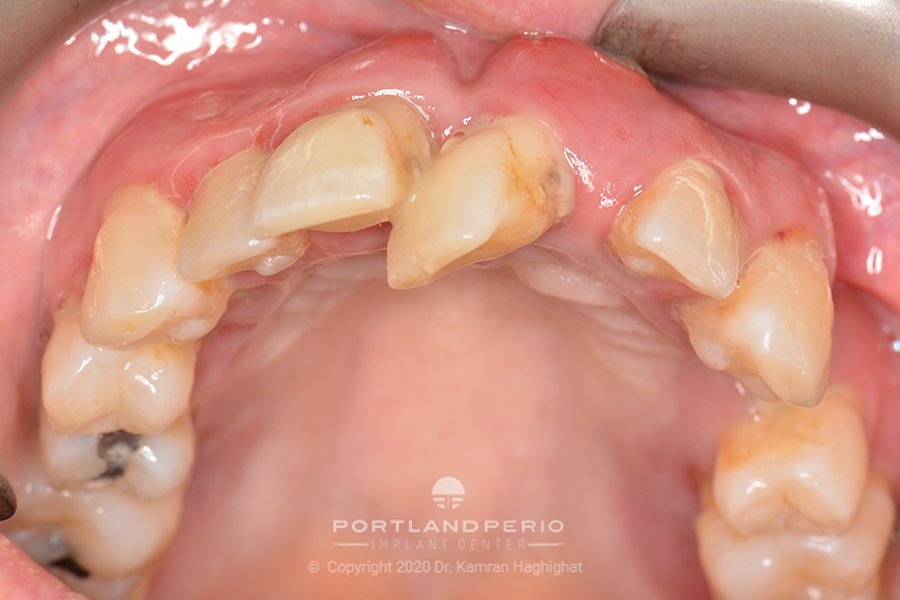 Upper arch of patient before All on Four dental implant treatment.