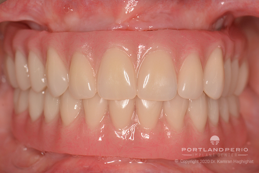Upper and lower arch of patient after All on Four dental implant treatment with Dr. Kamran Haghighat.