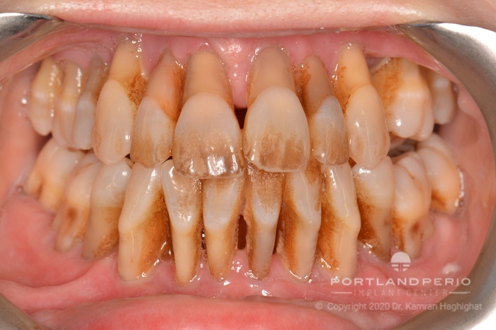 upper lower teeth before