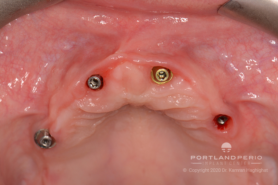 Upper jaw showing implants for All on Four dental implant treatment