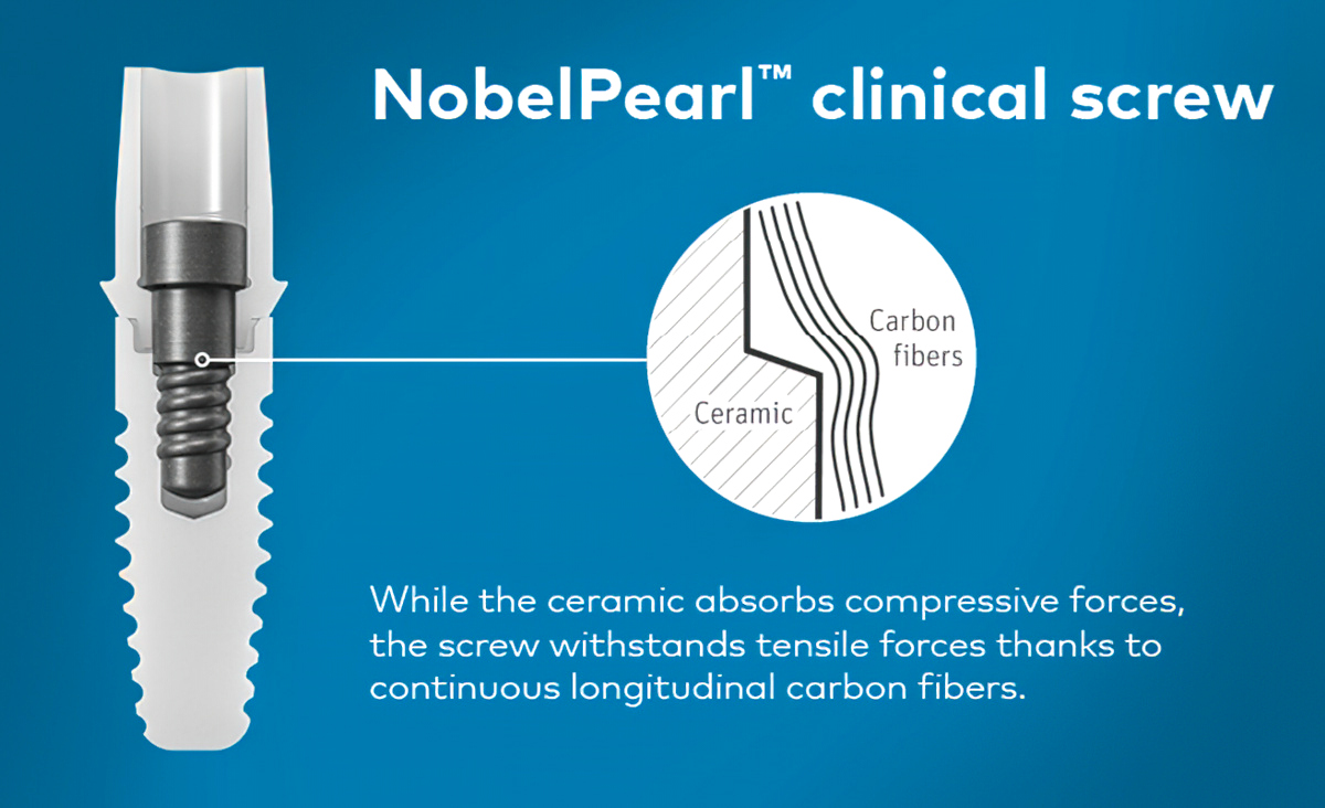 VICARBO screw - Nobel Pearl Implant - Portland Perio Implant Center