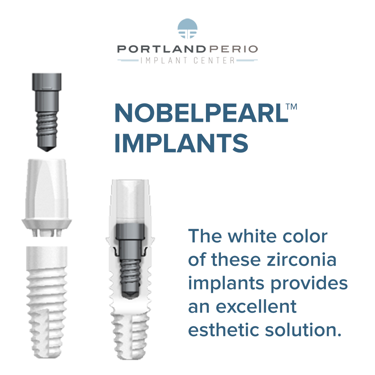 NobelPearl Ceramic Dental Implant - Portland Perio Implant Center - Dr. Kamran Haghighat
