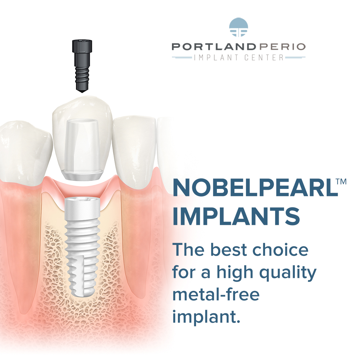 NoebelPearl Ceramic Dental Implants