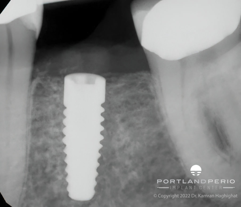 NobelPearl™ Ceramic Dental Implants PPIC