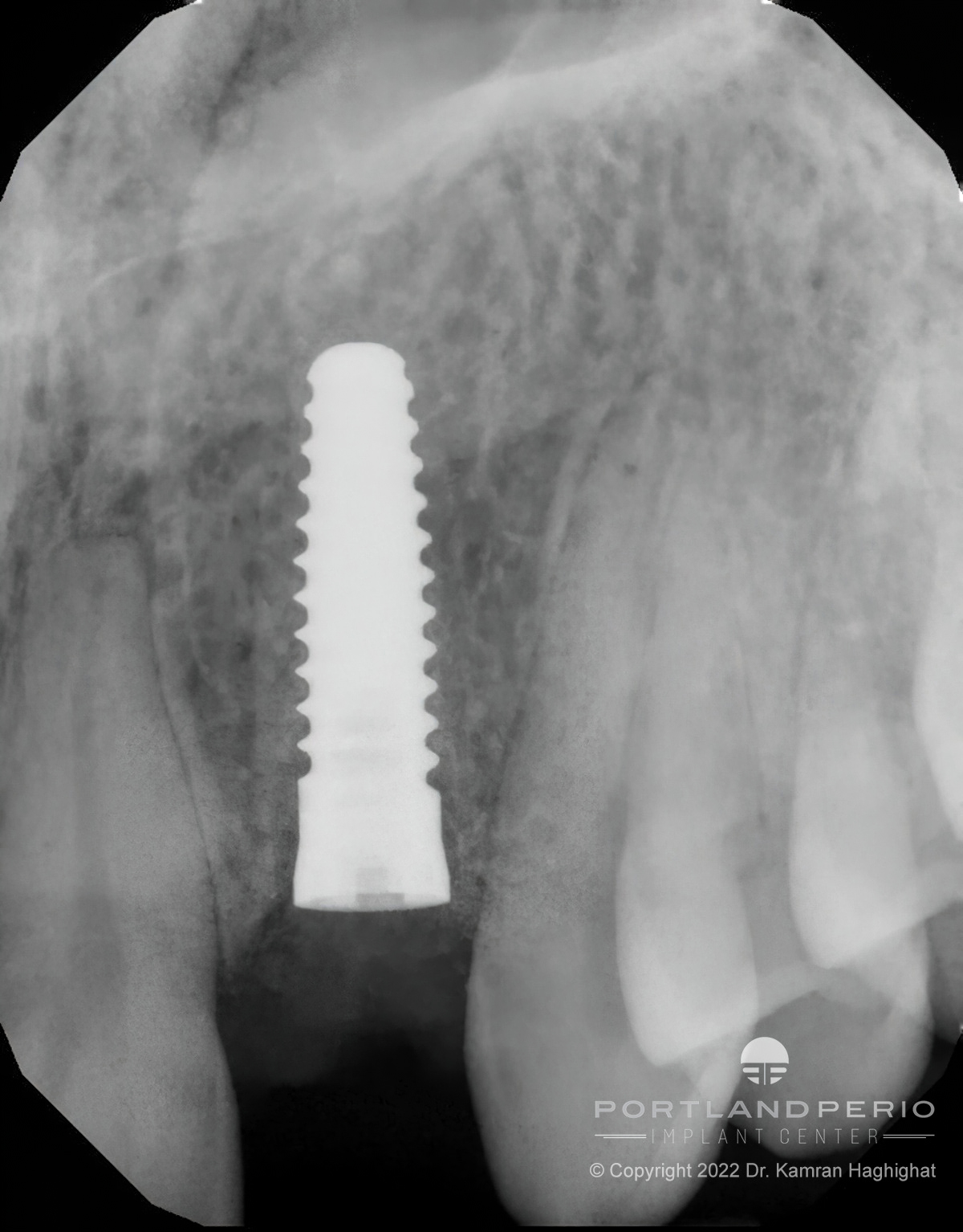NobelPearl Ceramic Dental Implant - Portland Perio Implant Center - Dr. Kamran Haghighat