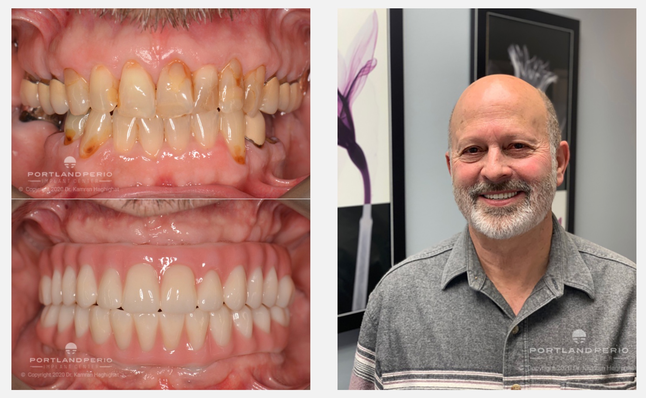 All On 4 Dental Implants Case Study - Mike
