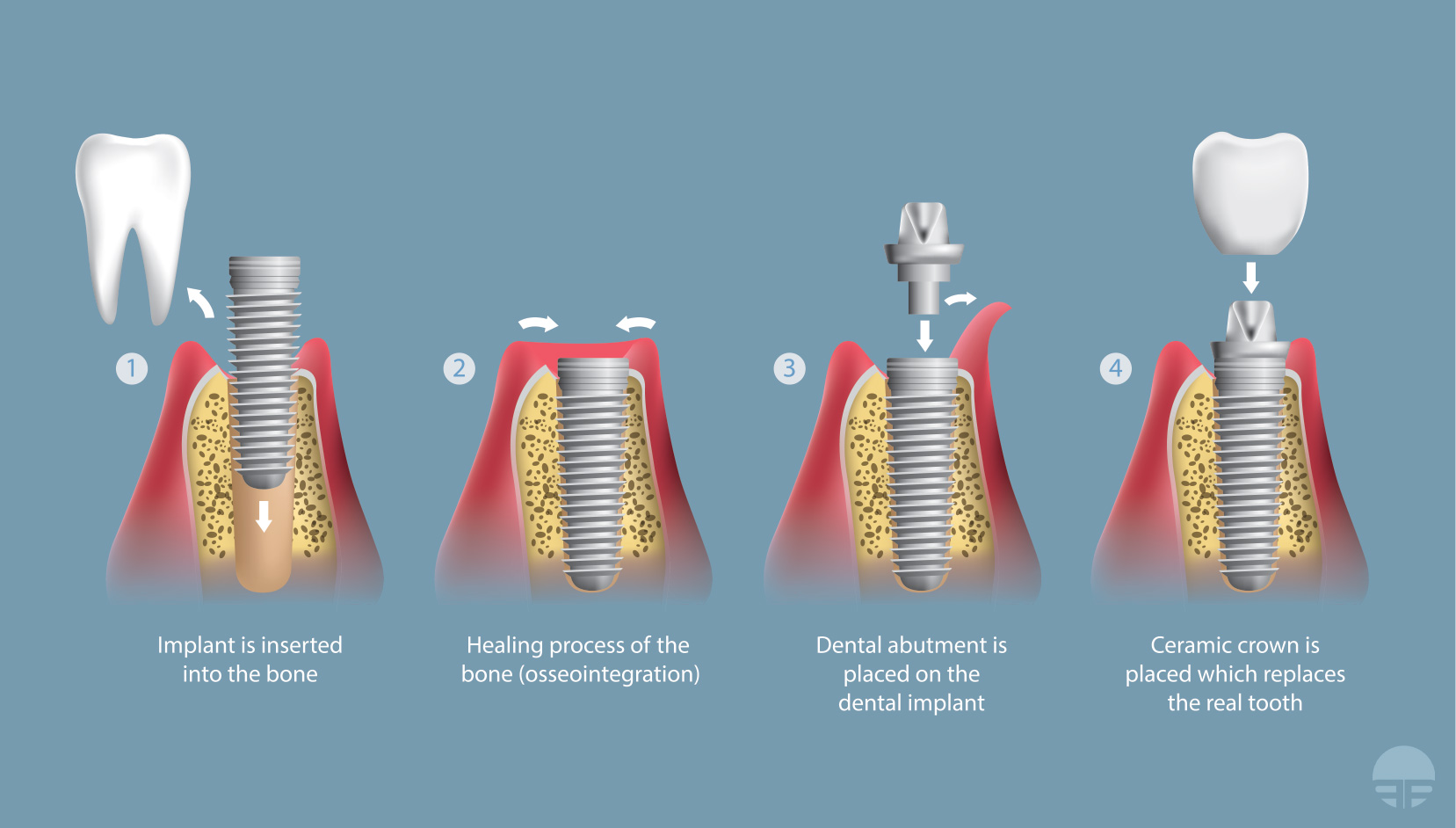 Dental Implant Illustration - Portland Perio Implant Center