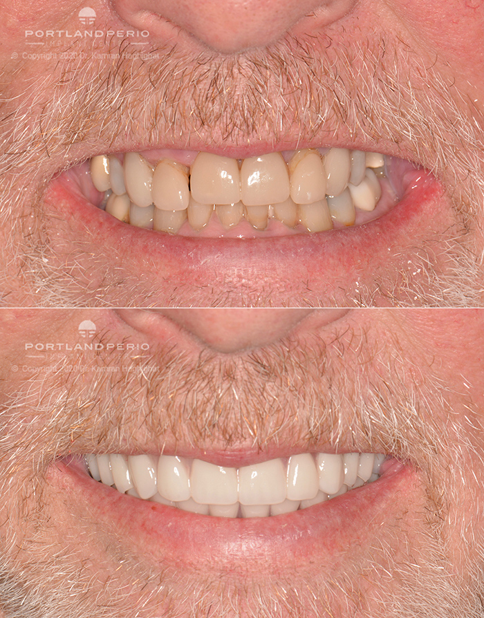 Patient Eric after treatment with all-on-4 dental implants.