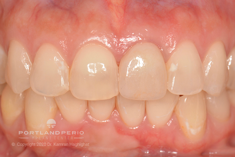 sarah_dental_implant_portland_perio_implant_center_04