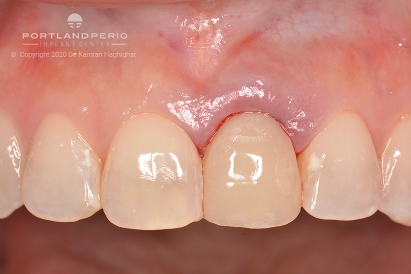 sarah_dental_implant_portland_perio_implant_center_06