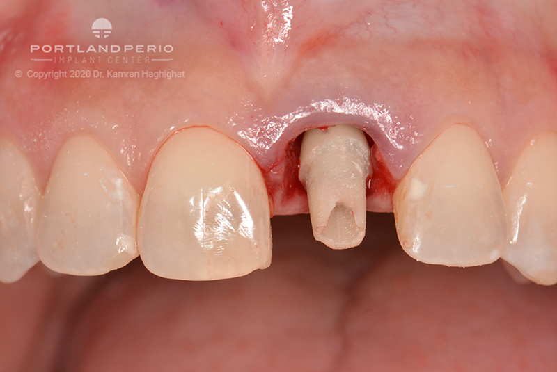 sarah_dental_implant_portland_perio_implant_center_07