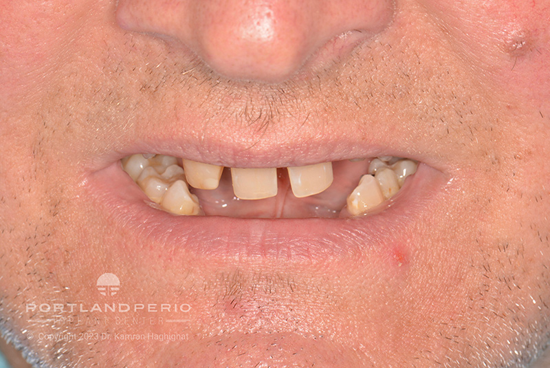 Patient's mouth before dental implants treatment at Portland Perio Implant Center.