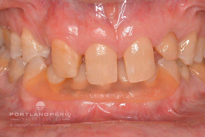 Patient's mouth before dental implant treatment at Portland Perio Implant Treatment.