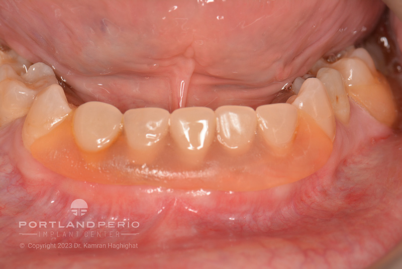 Patient's "before" dental implant treatment at Portland Perio Implant Center.