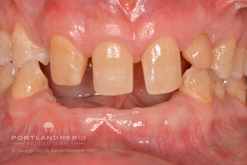 Patient's mouth before treatment with dental implants at Portland Perio Implant Center.