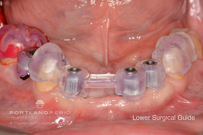 Lower jaw surgical guide before dental implants treatment at Portland Perio Implant Center.