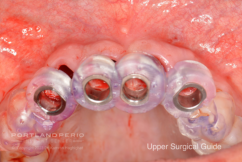 View of upper surgical guide before dental implants treatment at Portland Perio Implant Treatment.