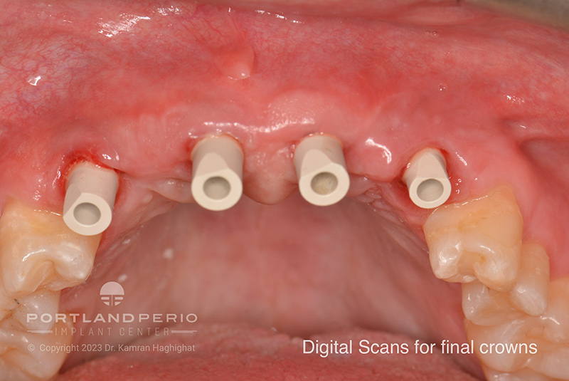 Digital scan for final crowns before dental implant treatment at Portland Perio Implant Center.