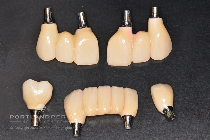 Final bridges for patient who received dental implant treatment at Portland Perio Implant Center.