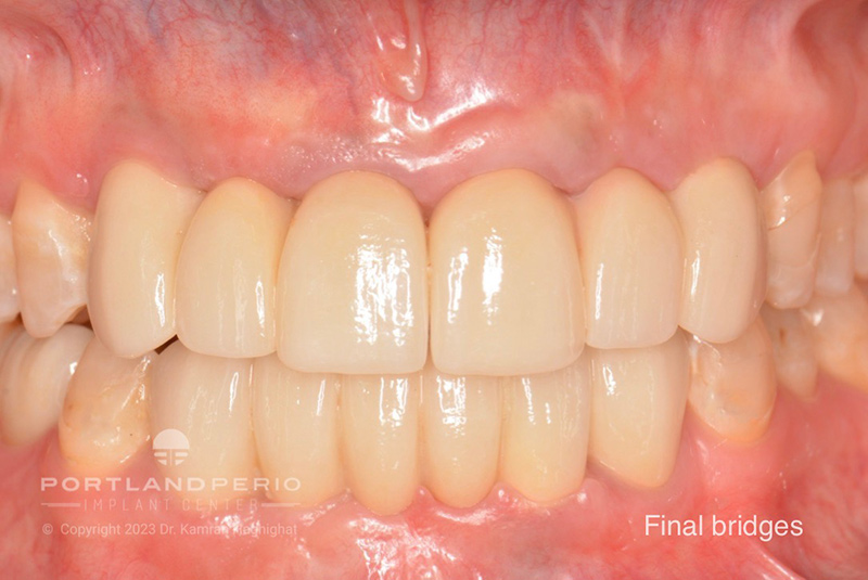 Final bridges for patient with dental implants at Portland Perio Implant Center.