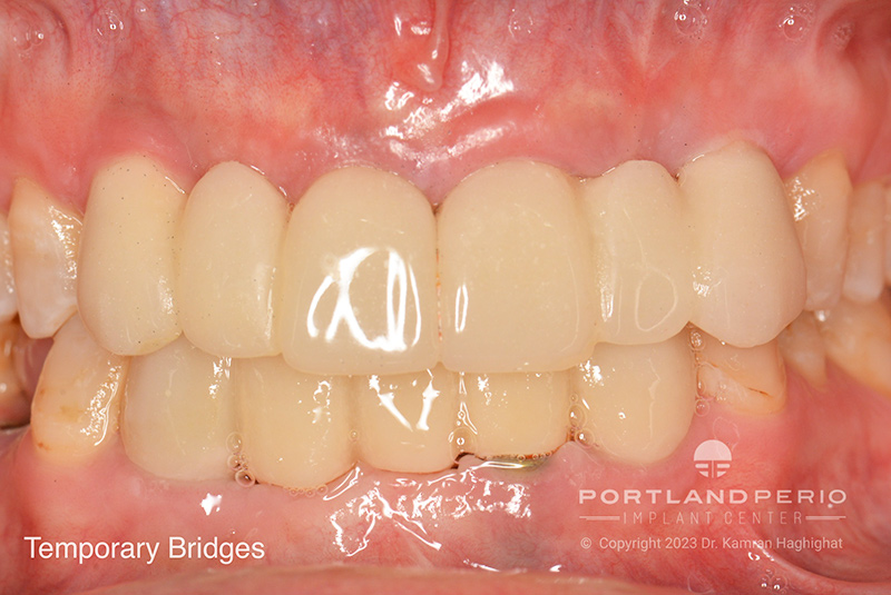 Temporary bridges for patient who received dental implant treatment at Portland Perio Implant Center.