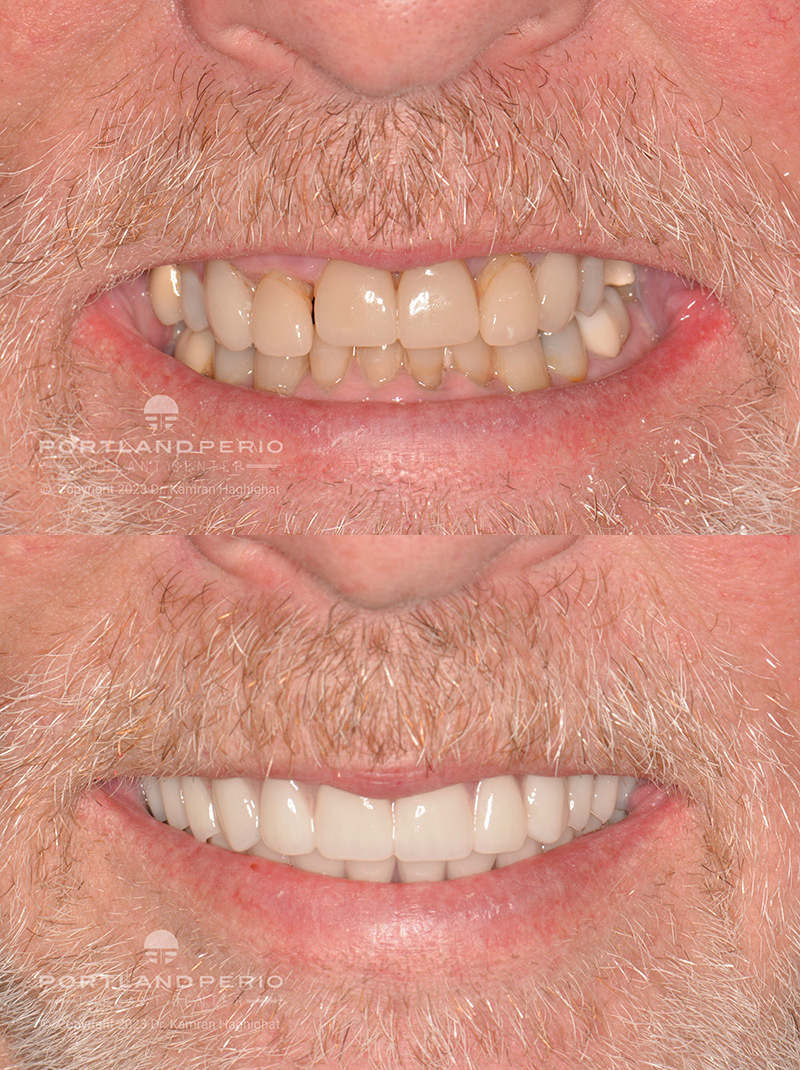Before and After - Eric's Smile Transformation with Double All On 4 Treatment - Portland Perio Implant Center, Portland, OR