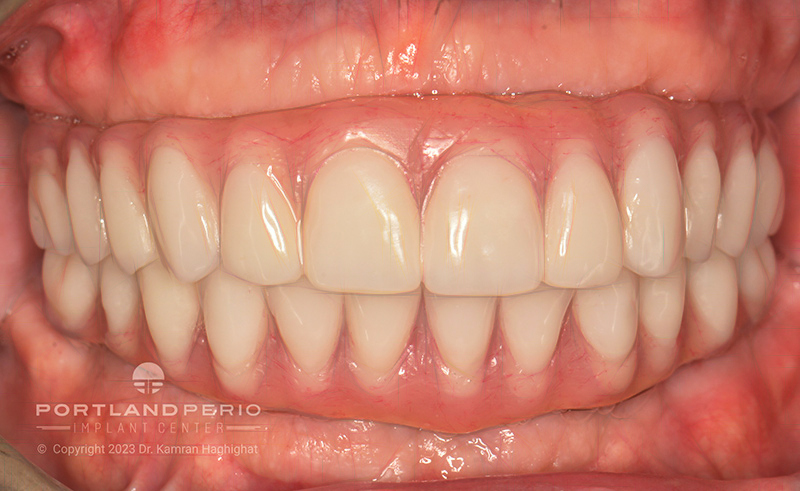 Eric's Smile Transformation with Double All On 4 Treatment - Portland Perio Implant Center, Portland, OR