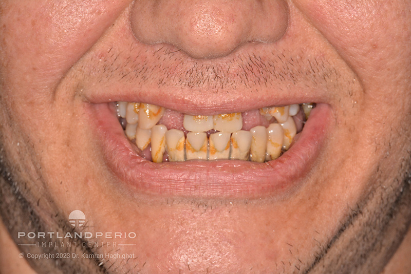 Patient at Portland Perio Implant Center before all on 4 dental implants.