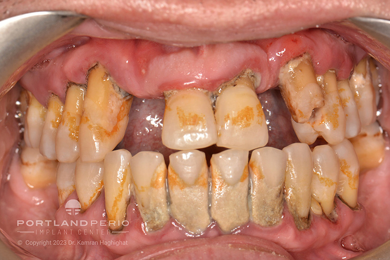 A patient at Portland Perio Implant Center before all on 4 dental implant treatment.