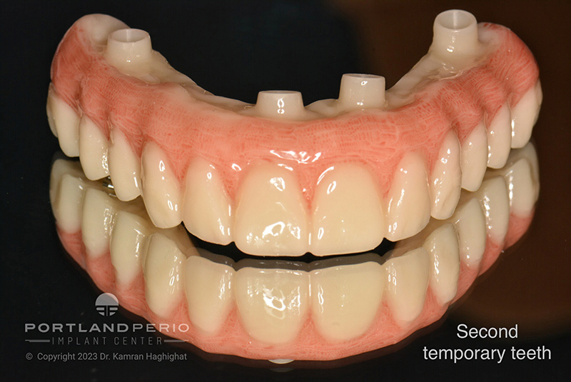 Temporary teeth for a patient at Portland Perio Implant Center with All on 4 Dental Implants.