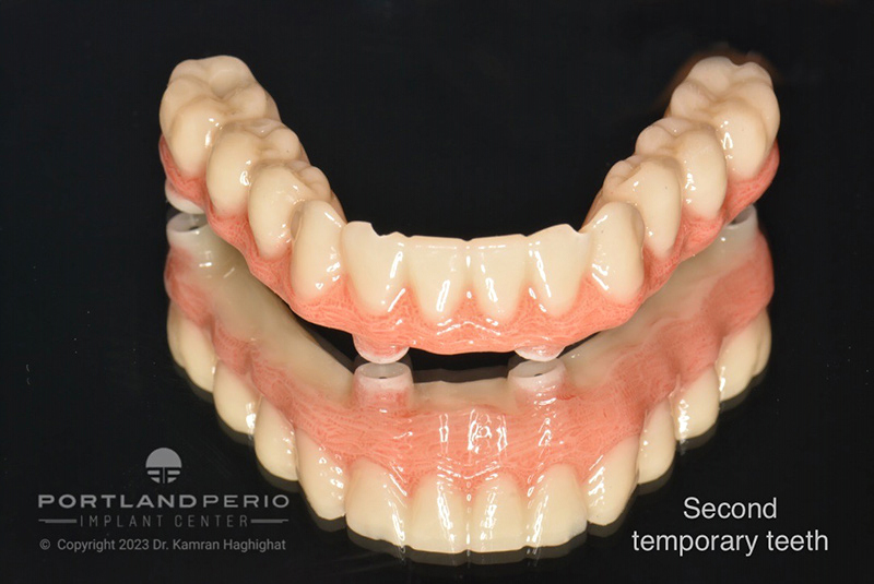 Patient at Portland Perio Implant Center with temporary "same day" teeth for all on 4 dental implants.