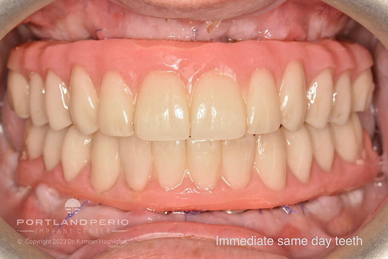 Temporary "same day" teeth for a patient at Portland Perio Implant Center.